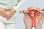 Pcos/Pcod